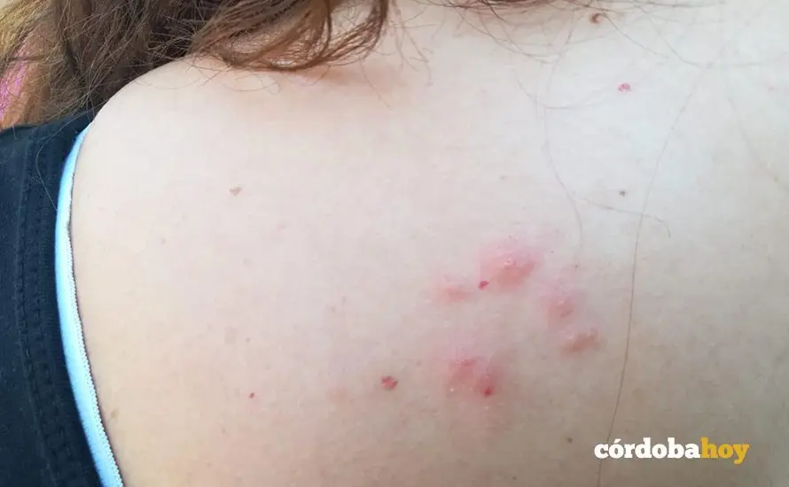 Efectos de los mosquitos en un adulto