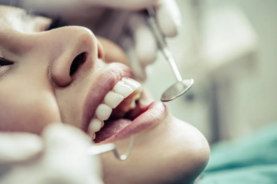  Carillas dentales ultrafinas: Est&eacute;tica natural sin tallado 