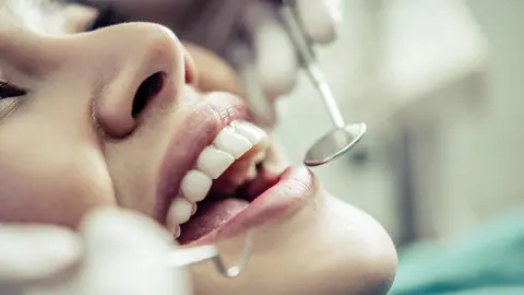  Carillas dentales ultrafinas: Est&eacute;tica natural sin tallado 