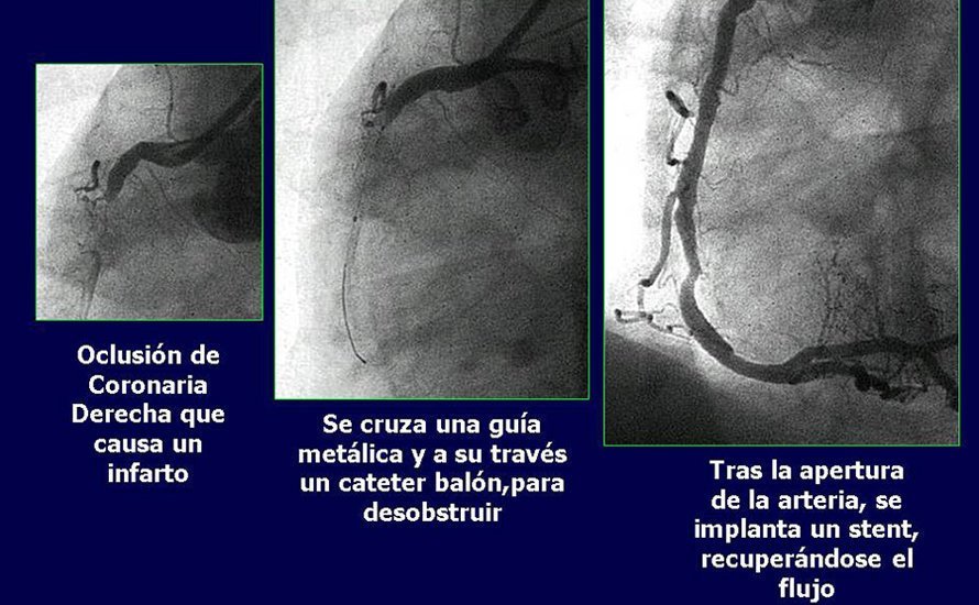 Foto arteria