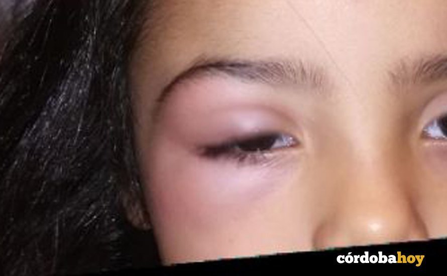 El efecto de una picadura en el ojo de una niña