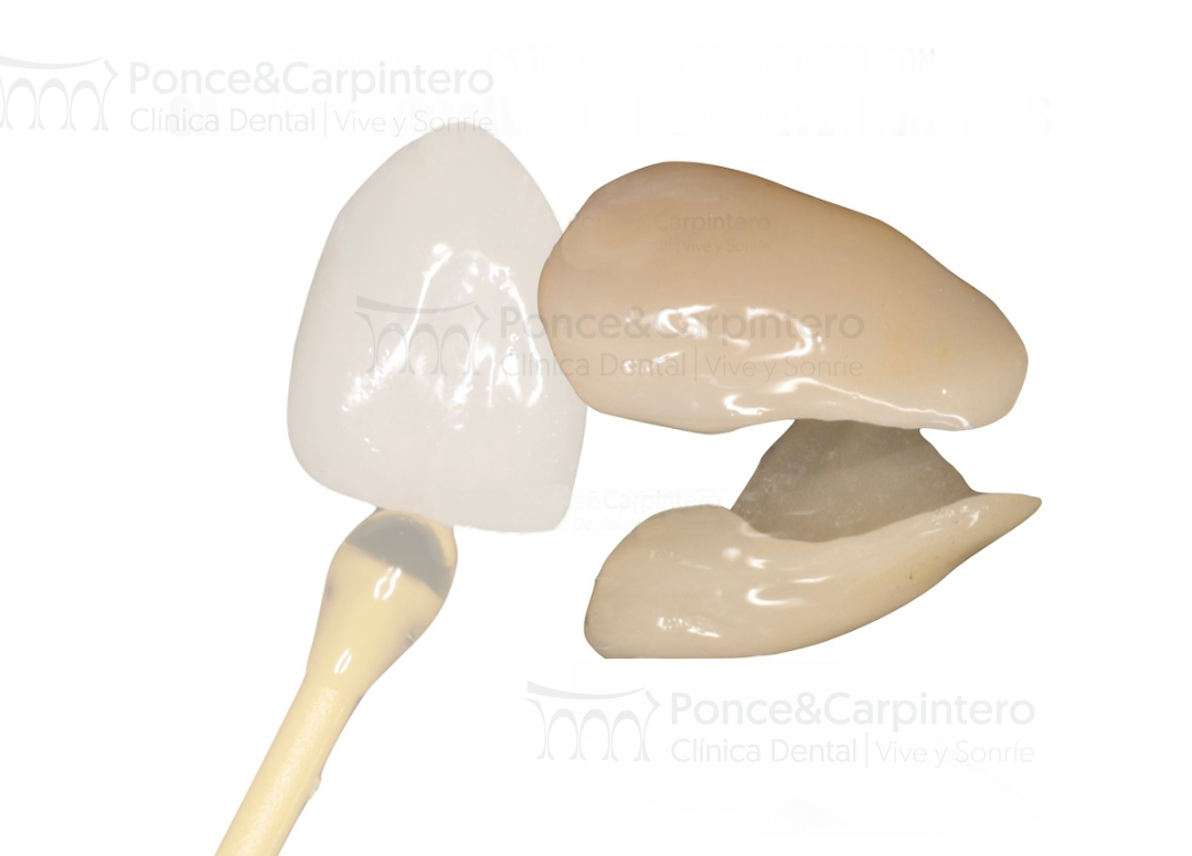 carillas dentales ponce y carpintero